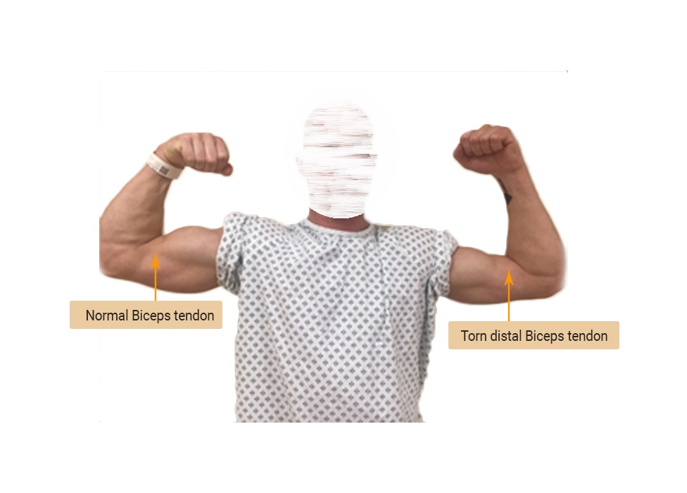 Distal-biceps-rupture