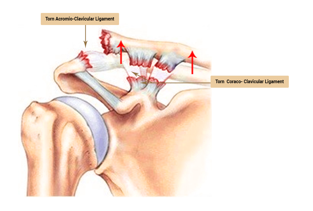London Upper Limb Surgery